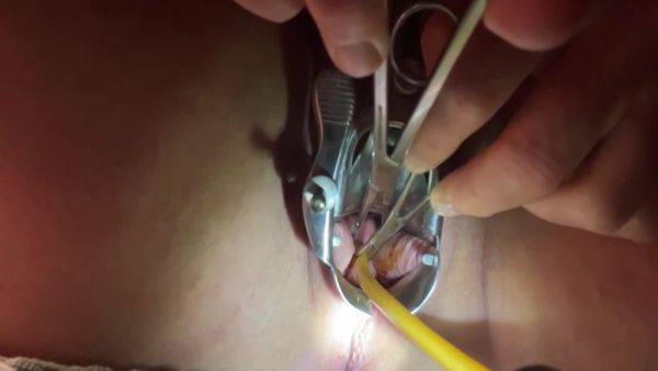 Tenaculum Grasping Cervix For Catheter 7 Min - hclips.com on v0d.com