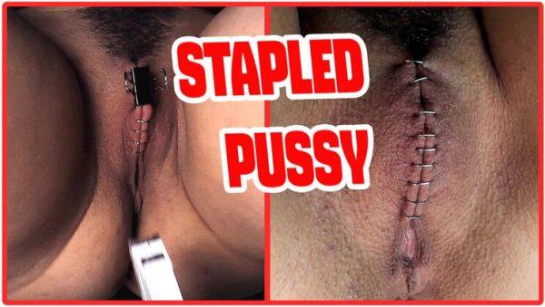 Sadistic Doctor Staples Teen Goth Girl's Hairy Pussy in Extreme BDSM Medical Punishment - veryfreeporn.com - Spain on v0d.com